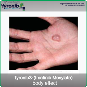 Leukaemia and soft tissue sarcoma